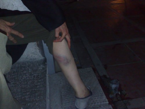 پای باتوم خورده یک پیرزن